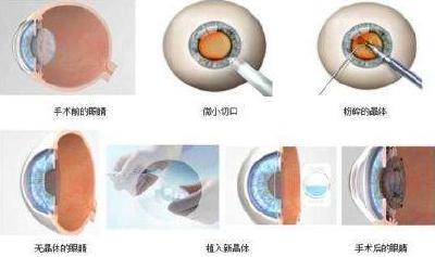 北京：本月起安装人工晶体 医保可支付1835元
