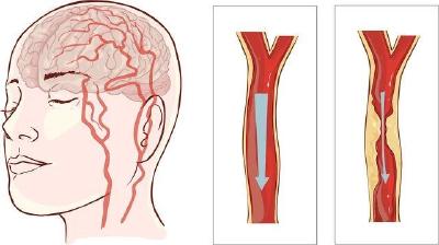 脑卒中起病急、病死率高，预防关键点在这里