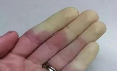 天一冷，手怎么变了颜色还很疼