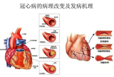 什么是冠心病的一级预防