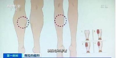 为瘦腿挑出神经？网络热传的这种手术堪称“自残”
