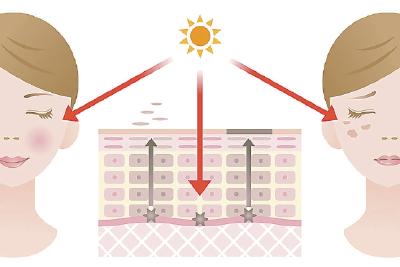 夏天色斑恼人 哪些可激光去除