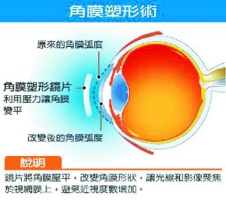 守护青少年眼健康 角膜塑形镜验配须规范先行