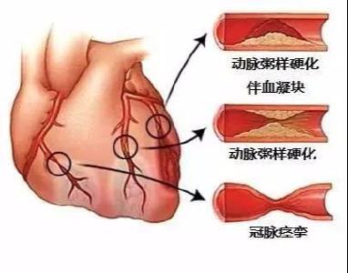 经常熬夜 患冠心病风险最高