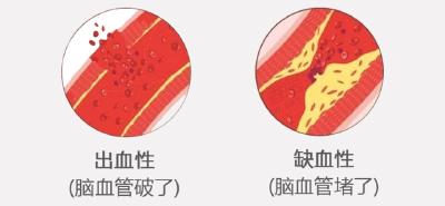 心头一颤并发症竟是脑卒中