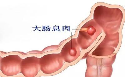 体检报告上的结节、息肉、囊肿是虚惊一场还是救命提醒？