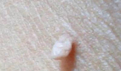 身上长出的“小肉粒”会癌变吗？看到这样的“小肉粒”要小心！ 