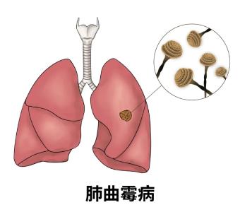 女子大扫除后高烧40℃、肺部“发霉”！只因忽略这个细节
