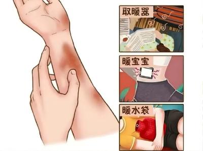 看不见的“温柔刀” 冬季低温烫伤高发需警惕 