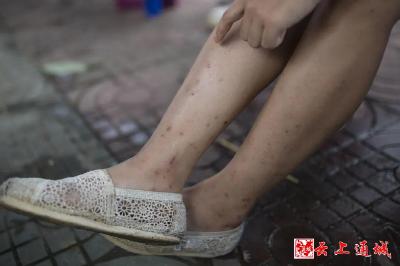 蚊子包越大毒性越强？真相其实是…
