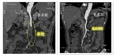 通城县人民医院胃肠外科成功开展肠系膜上动脉切开取栓术