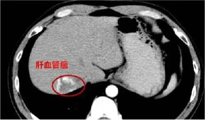 一张照片竟被网友看出血管瘤 身体出现这3个信号要当心