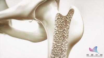 一学生掰手腕，竟致粉碎性骨折！年纪轻轻就骨质疏松了？这些习惯必须改…