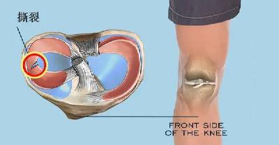 「半月板」最怕的一个动作，分分钟加速它的“报废”