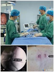 零的突破！崇阳县中医院成功开展县内首例单侧双通道内镜（UBE）治疗脊柱疾病技术