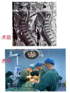 崇阳县中医院完成首例高风险高难度颈椎手术