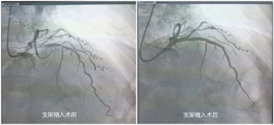 崇阳县人民医院开展县内首例IVUS（血管内超声）指导下PCI手术