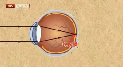 侧躺刷手机，小心迎来中年近视！一个动作缓解眼疲劳、水肿、黑眼圈...
