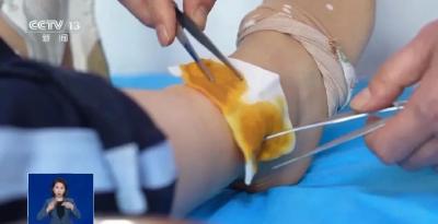 热水袋竟致三级烫伤！谁说温度低就不会烫伤了？
