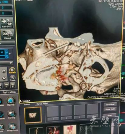 同济赤壁医院创赤壁市首例三叉神经痛治疗技术