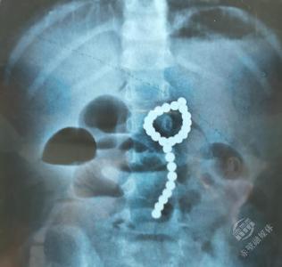 4岁女孩吞下26颗磁力珠 肠道磨穿6个洞