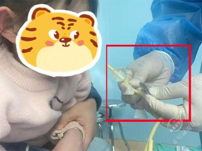 游戏币卡女童食道，赤壁市人民医院医师妙手取出