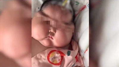 婴儿使用抑菌霜后成“大头娃娃”？下架！调查！