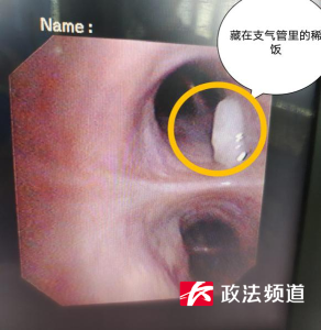 一碗稀饭下肚，他直接进了ICU