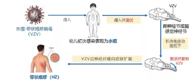 好消息！带状疱疹疫苗来啦！