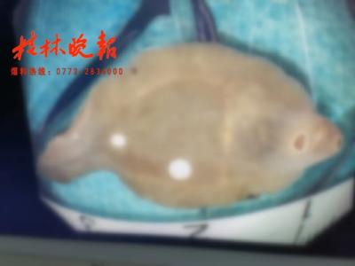 女子肝脏被“吃掉”三分之一，元凶竟是体内这条“鱼”