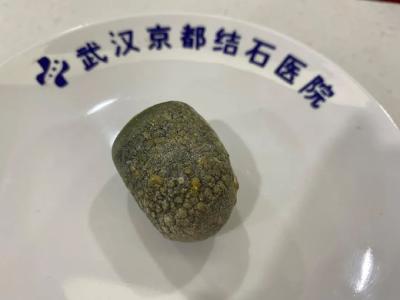爱吃肥肉、猪蹄、三餐不定，女子腹痛就医胆囊长满结石……