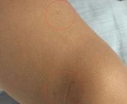 幼儿园老师针扎女童，事发后监控被删