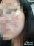 南昌一商场体验化妆活动致多名学生脸部糜烂