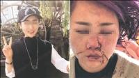 女子在丽江遭暴打毁容后续：与6名被告达成和解撤诉
