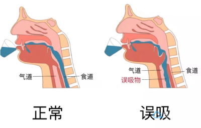 吞咽障碍患者的福音（一）——吞咽造影技术