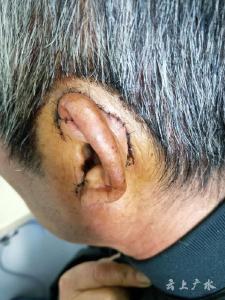 断耳缝合！广水一医院成功完成离断耳廓修复手术