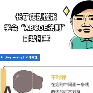 健康科普 | 痣会癌变？符合这3个特征最危险