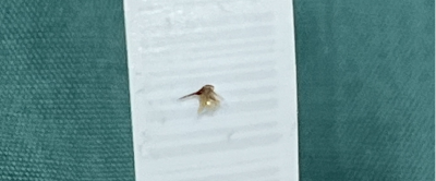 夷陵人民医院联合卫生院成功救治蜜蜂蜇伤口腔罕见病例