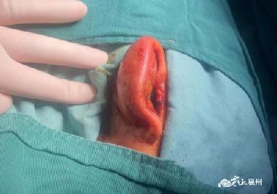 16岁女孩软骨上打耳洞  引发软骨膜炎导致耳廓畸形
