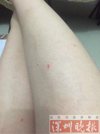 女子入住深圳一商务酒店 半夜被十几只臭虫咬醒