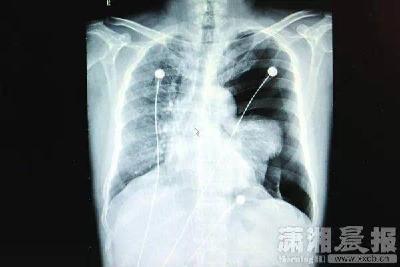 千万不要这样唱歌!有人偏瘫失语 有人肺