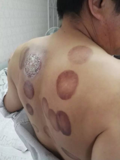 男子拔完火罐后右肺竟