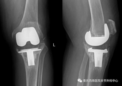 全球首例！医生借助3D打印为84岁老人翻修膝关节
