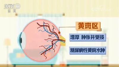 【联合国糖尿病日】我国糖尿病人过亿 警惕并发症