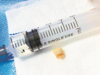 虎妈一掌把儿子乳牙打入气管
