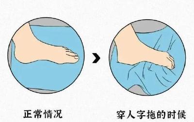 当心这种鞋 ↑ 夏天很多黄冈人爱穿