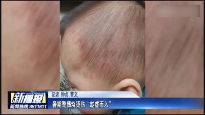 生活小贴士｜ 暑期警惕烫烧伤“趁虚而入”
