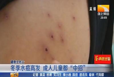 冬季水痘高发 成人儿童都“中招”
