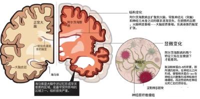 吃对饭菜，远离老年痴呆！最新科学饮食模式收好！